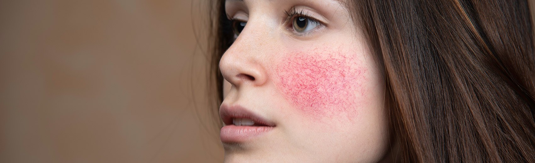 Rosacea - Ginsburg Dermatology Center and Medical Spa